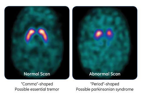 DaTscan image of the brain